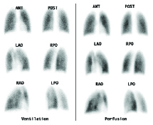 Lung Scan